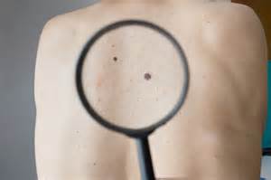 Lancet Oncol：BRAF-V600晚期黑色素瘤双靶向可改善患者生存